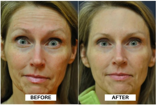 A before-and-after comparison highlighting the transformative effects of Botox.