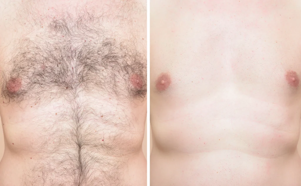 A before-and-after comparison showing the effective results of laser hair removal.