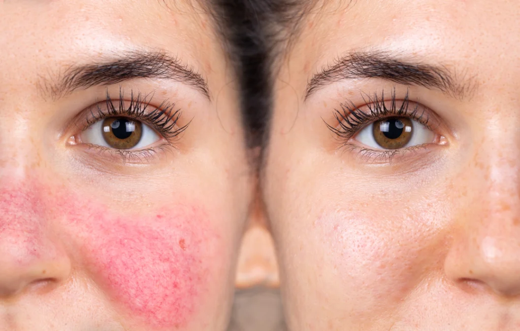 A close-up of rosacea redness before and after rosacea treatment with IPL, showing reduced facial redness.