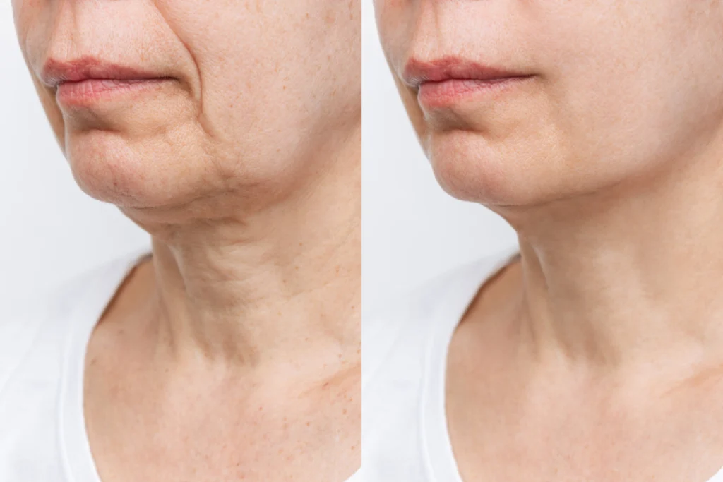 Side-by-side comparison showing the reduction of neck wrinkles before and after Dysport treatment.