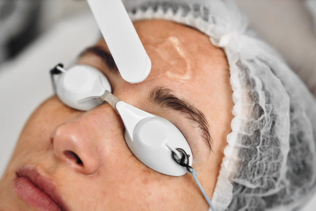 A patient receiving an IPL laser treatment with protective eyewear.